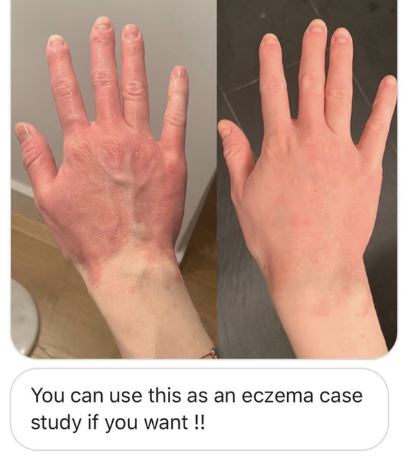 Skin Concern: Eczema